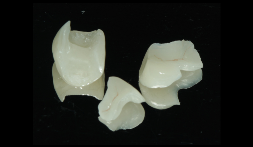 藍(lán)瓷貼面、嵌體